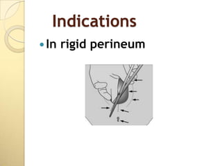 Indications
 In   rigid perineum
 