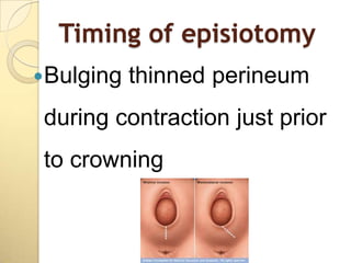 Timing of episiotomy
Bulging   thinned perineum
during contraction just prior
to crowning
 