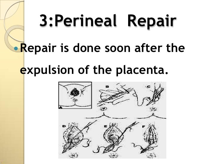Presentation episiotomy