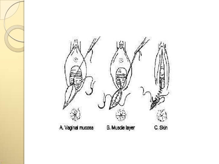 Presentation Episiotomy presentation-episiotomy