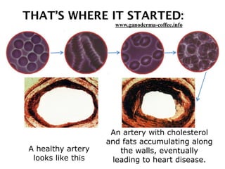 THAT’S WHERE IT STARTED:
A healthy artery
looks like this
An artery with cholesterol
and fats accumulating along
the walls, eventually
leading to heart disease.
www.ganoderma-coffee.info
 