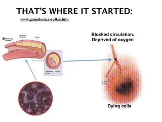 THAT’S WHERE IT STARTED:
Dying cells
Blocked circulation.
Deprived of oxygen
www.ganoderma-coffee.info
 