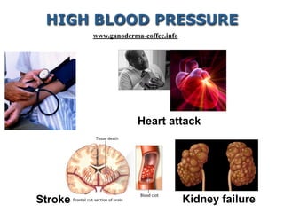 Heart attack
Kidney failure
HIGH BLOOD PRESSURE
Stroke
www.ganoderma-coffee.info
 