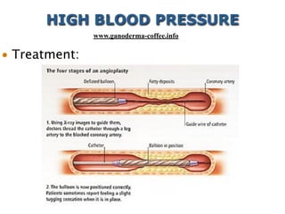 • Treatment:
HIGH BLOOD PRESSURE
www.ganoderma-coffee.info
 