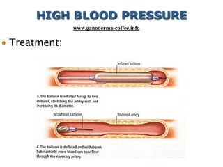 • Treatment:
HIGH BLOOD PRESSURE
www.ganoderma-coffee.info
 