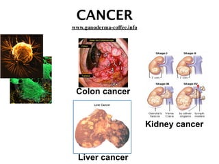 CANCER
Colon cancer
Liver cancer
Kidney cancer
www.ganoderma-coffee.info
 