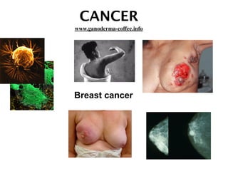 CANCER
Breast cancer
www.ganoderma-coffee.info
 