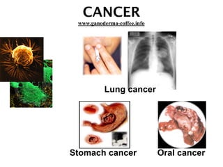 CANCER
Stomach cancer Oral cancer
Lung cancer
www.ganoderma-coffee.info
 