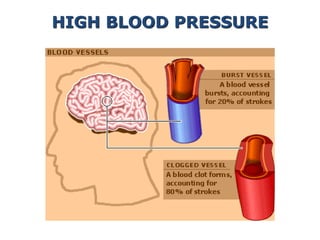 HIGH BLOOD PRESSURE
 