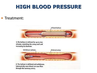 • Treatment:
HIGH BLOOD PRESSURE
 