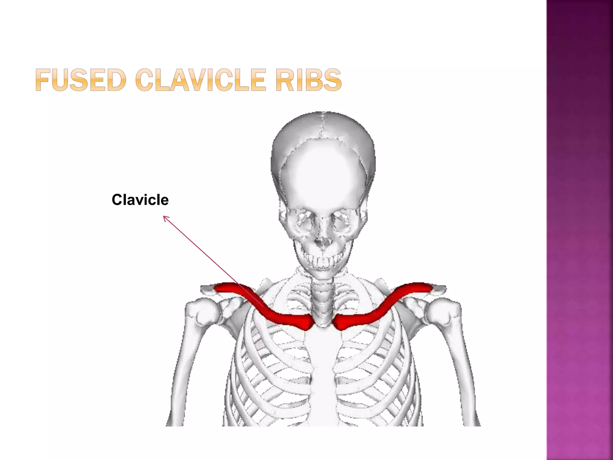 Clavicle
 