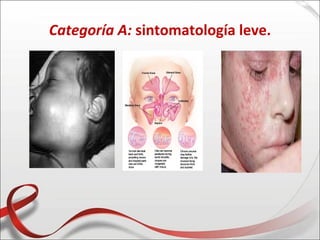 Categoría A: sintomatología leve.
 