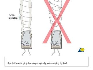 Apply the overlying bandages spirally, overlapping by half.
 