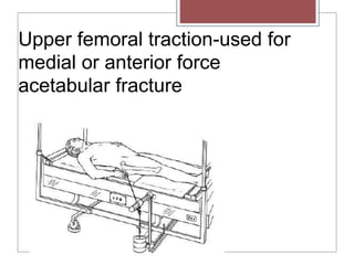 Upper femoral traction-used for
medial or anterior force
acetabular fracture
 
