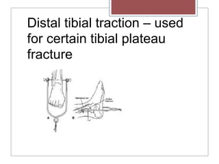 Distal tibial traction – used
for certain tibial plateau
fracture
 