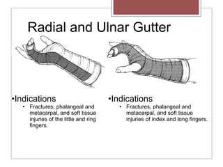 Radial and Ulnar Gutter
•Indications
• Fractures, phalangeal and
metacarpal, and soft tissue
injuries of the little and ring
fingers.
•Indications
• Fractures, phalangeal and
metacarpal, and soft tissue
injuries of index and long fingers.
 