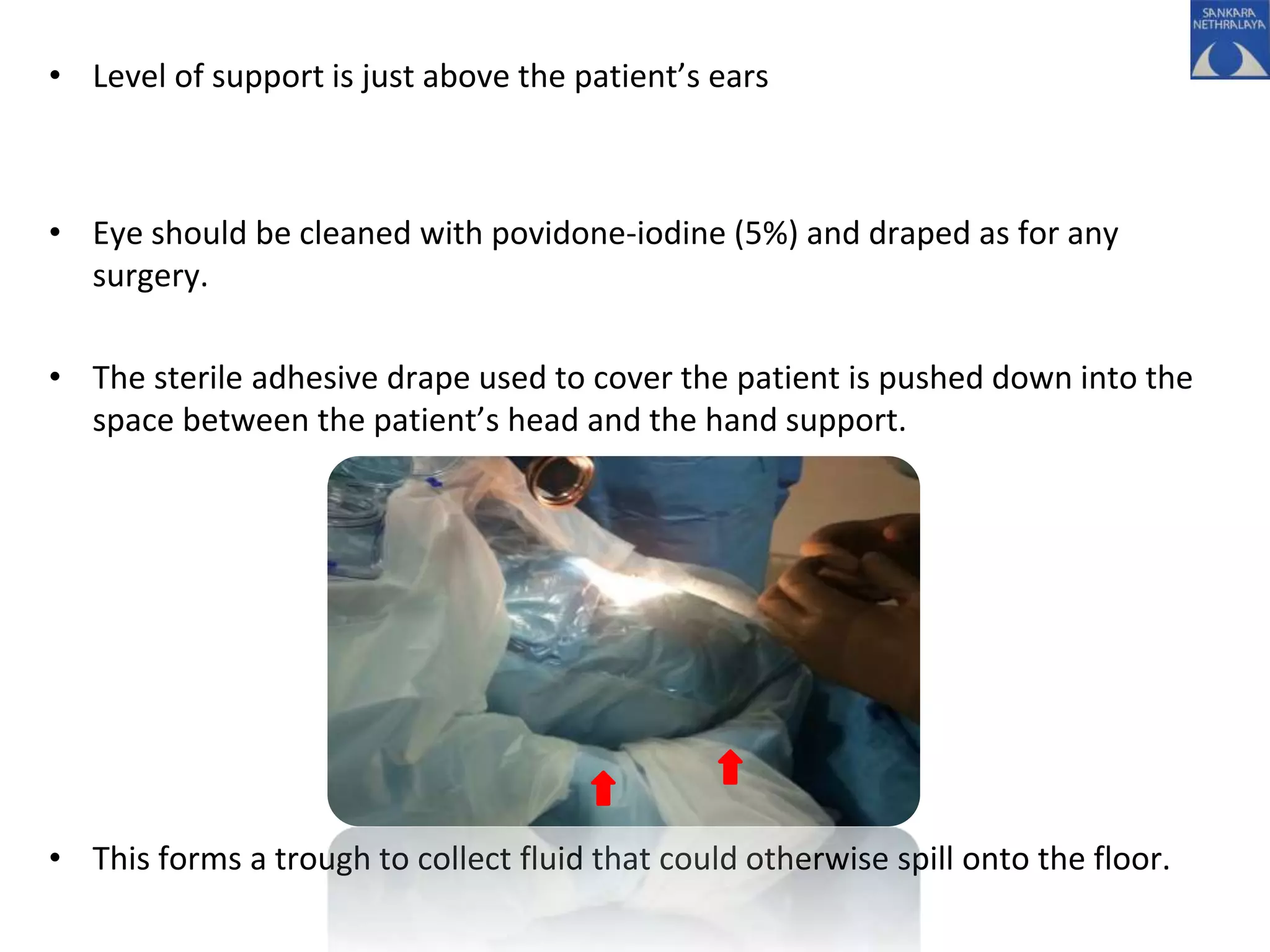 • Level of support is just above the patient’s ears
• Eye should be cleaned with povidone-iodine (5%) and draped as for any
surgery.
• The sterile adhesive drape used to cover the patient is pushed down into the
space between the patient’s head and the hand support.
• This forms a trough to collect fluid that could otherwise spill onto the floor.
 
