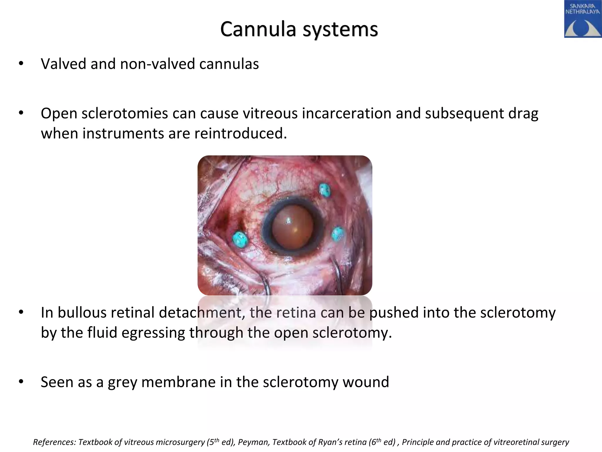 Cannula systems
• Valved and non-valved cannulas
• Open sclerotomies can cause vitreous incarceration and subsequent drag
when instruments are reintroduced.
• In bullous retinal detachment, the retina can be pushed into the sclerotomy
by the fluid egressing through the open sclerotomy.
• Seen as a grey membrane in the sclerotomy wound
References: Textbook of vitreous microsurgery (5th ed), Peyman, Textbook of Ryan’s retina (6th ed) , Principle and practice of vitreoretinal surgery
 