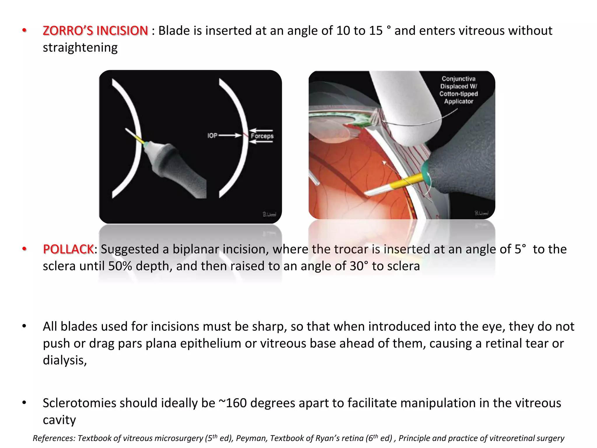 • ZORRO’S INCISION : Blade is inserted at an angle of 10 to 15 ° and enters vitreous without
straightening
• POLLACK: Suggested a biplanar incision, where the trocar is inserted at an angle of 5° to the
sclera until 50% depth, and then raised to an angle of 30° to sclera
• All blades used for incisions must be sharp, so that when introduced into the eye, they do not
push or drag pars plana epithelium or vitreous base ahead of them, causing a retinal tear or
dialysis,
• Sclerotomies should ideally be ~160 degrees apart to facilitate manipulation in the vitreous
cavity
References: Textbook of vitreous microsurgery (5th ed), Peyman, Textbook of Ryan’s retina (6th ed) , Principle and practice of vitreoretinal surgery
 