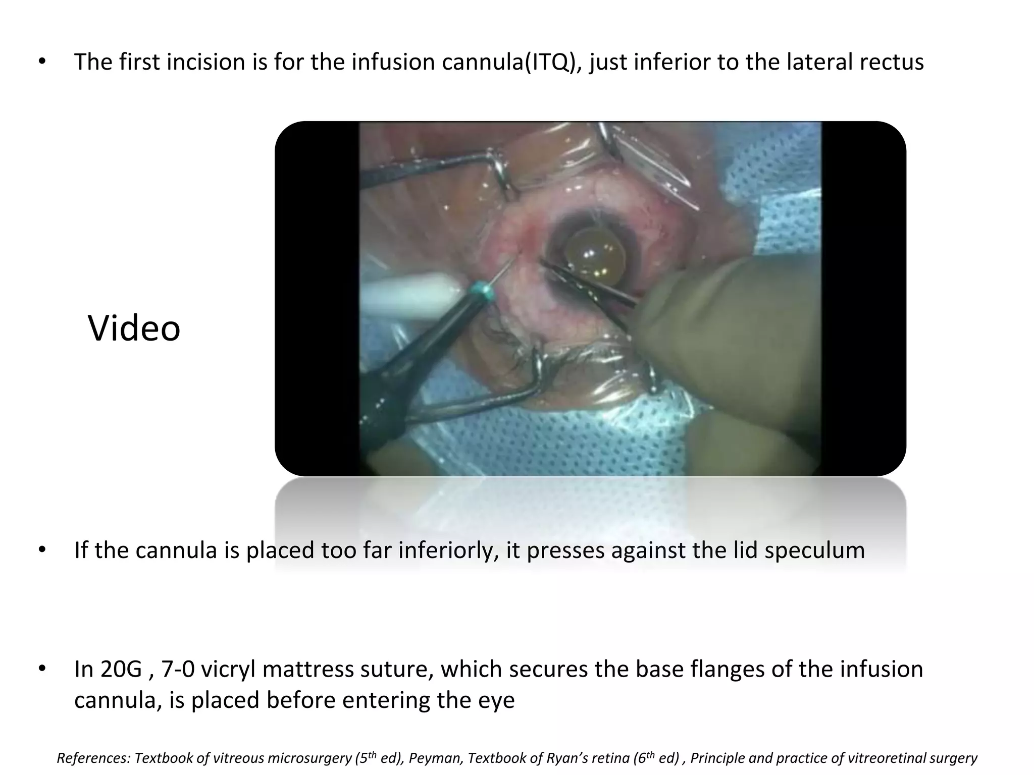 Video
• The first incision is for the infusion cannula(ITQ), just inferior to the lateral rectus
• If the cannula is placed too far inferiorly, it presses against the lid speculum
• In 20G , 7-0 vicryl mattress suture, which secures the base flanges of the infusion
cannula, is placed before entering the eye
References: Textbook of vitreous microsurgery (5th ed), Peyman, Textbook of Ryan’s retina (6th ed) , Principle and practice of vitreoretinal surgery
 