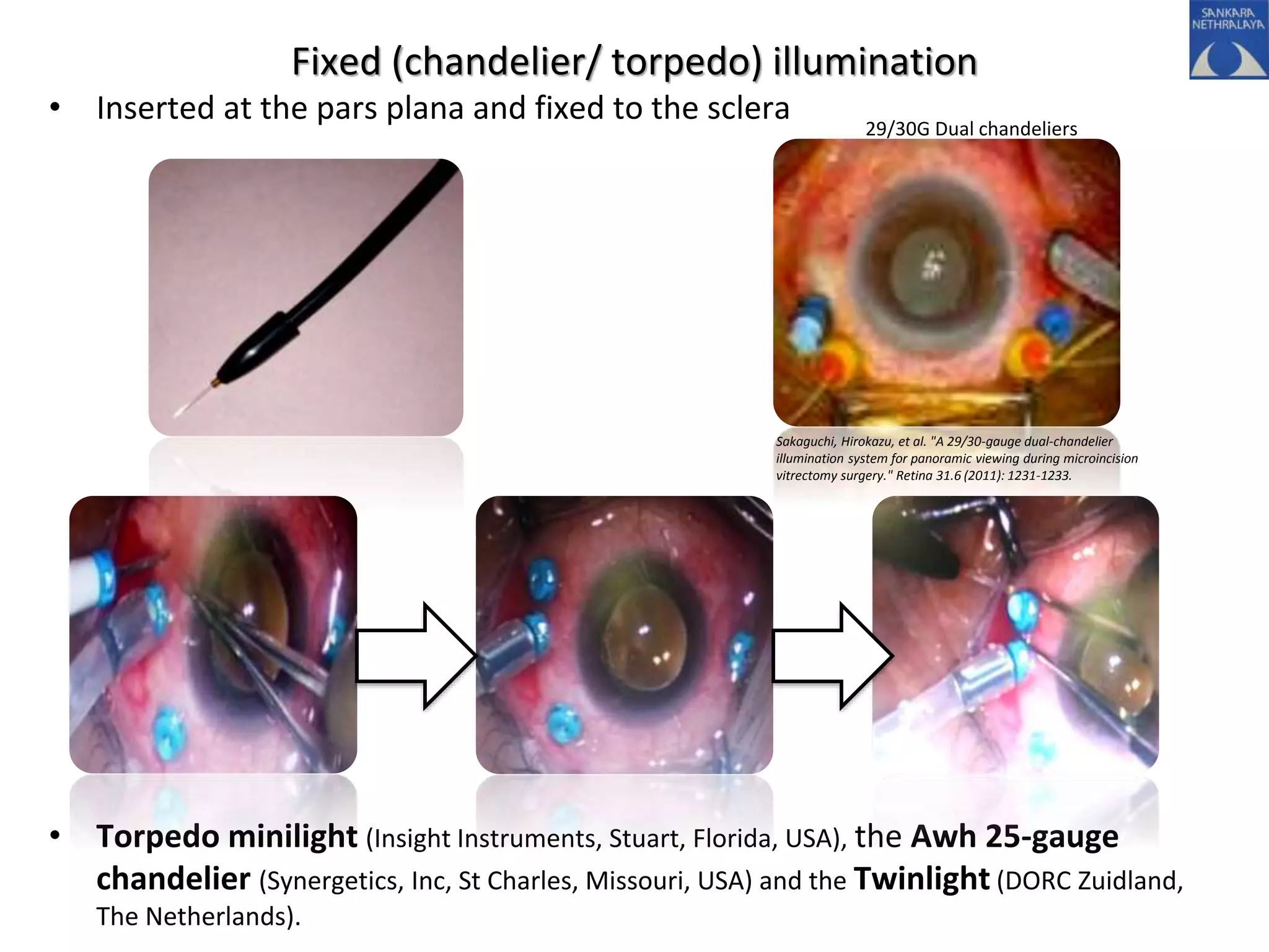 Fixed (chandelier/ torpedo) illumination
• Inserted at the pars plana and fixed to the sclera
• Torpedo minilight (Insight Instruments, Stuart, Florida, USA), the Awh 25-gauge
chandelier (Synergetics, Inc, St Charles, Missouri, USA) and the Twinlight (DORC Zuidland,
The Netherlands).
29/30G Dual chandeliers
Sakaguchi, Hirokazu, et al. "A 29/30-gauge dual-chandelier
illumination system for panoramic viewing during microincision
vitrectomy surgery." Retina 31.6 (2011): 1231-1233.
 