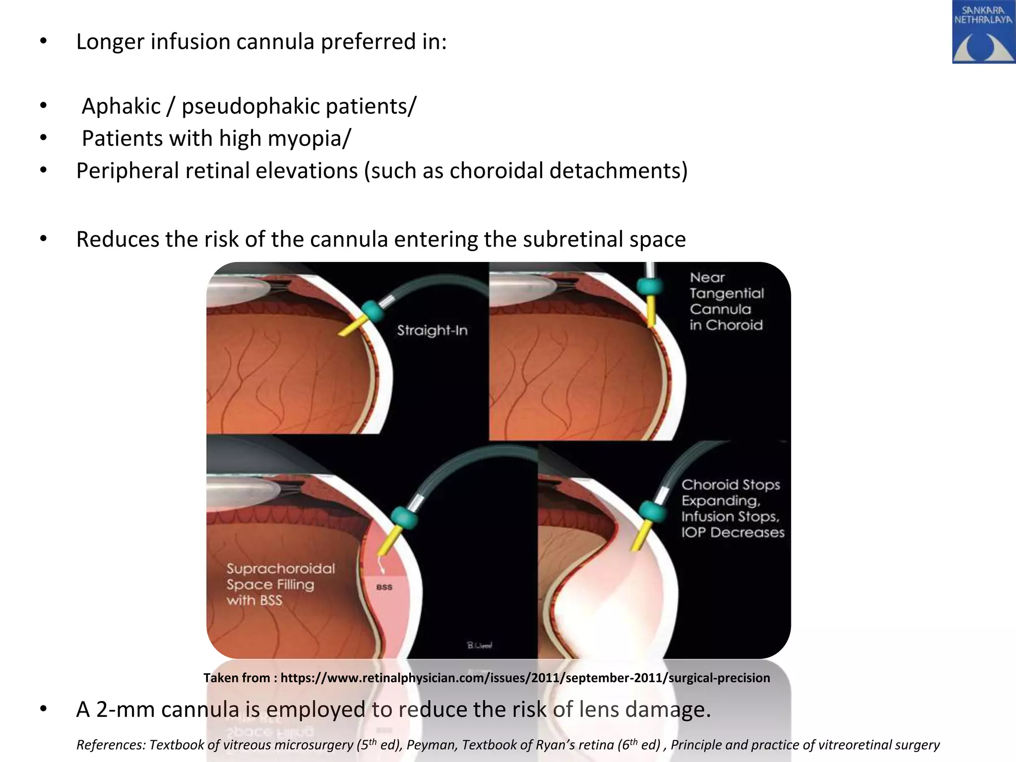 • Longer infusion cannula preferred in:
• Aphakic / pseudophakic patients/
• Patients with high myopia/
• Peripheral retinal elevations (such as choroidal detachments)
• Reduces the risk of the cannula entering the subretinal space
• A 2-mm cannula is employed to reduce the risk of lens damage.
Taken from : https://www.retinalphysician.com/issues/2011/september-2011/surgical-precision
References: Textbook of vitreous microsurgery (5th ed), Peyman, Textbook of Ryan’s retina (6th ed) , Principle and practice of vitreoretinal surgery
 