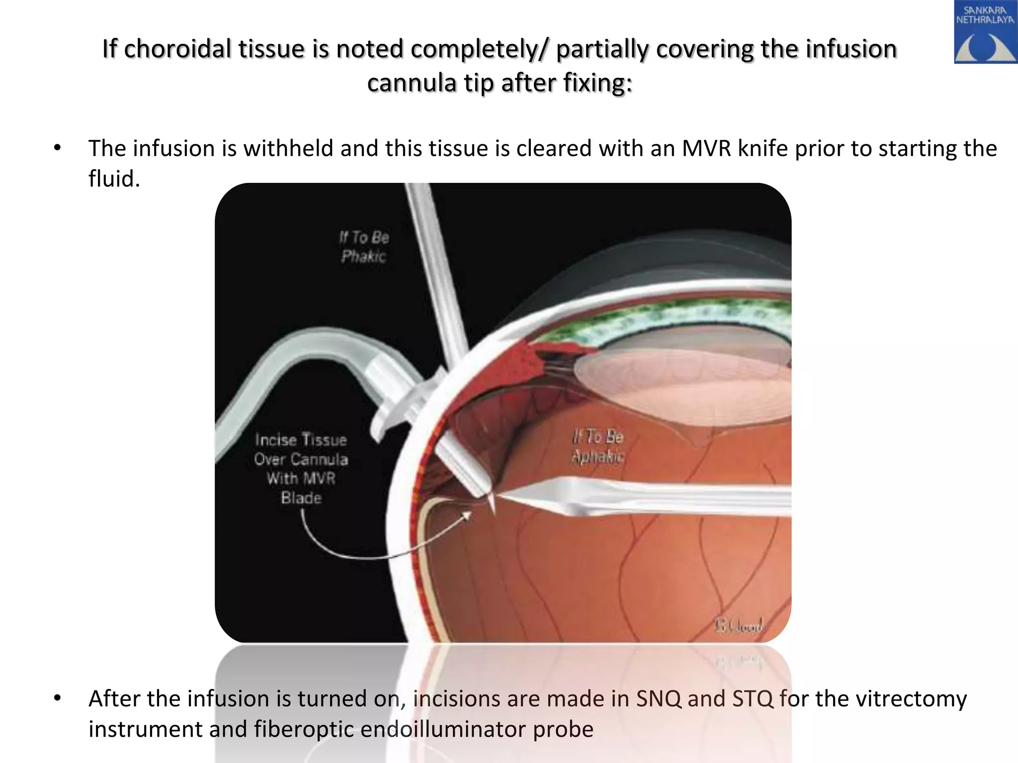 If choroidal tissue is noted completely/ partially covering the infusion
cannula tip after fixing:
• The infusion is withheld and this tissue is cleared with an MVR knife prior to starting the
fluid.
• After the infusion is turned on, incisions are made in SNQ and STQ for the vitrectomy
instrument and fiberoptic endoilluminator probe
 