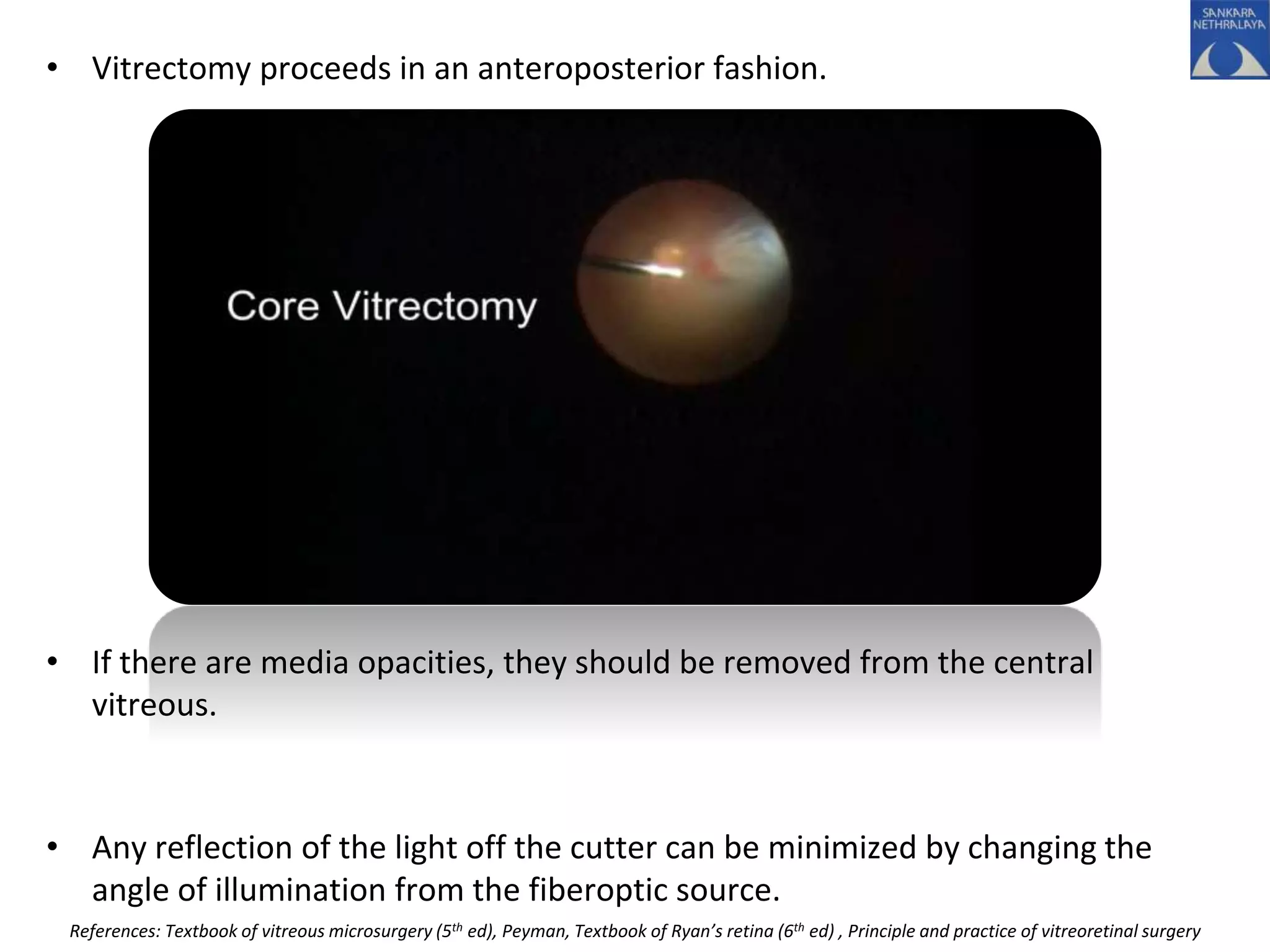 • Vitrectomy proceeds in an anteroposterior fashion.
• If there are media opacities, they should be removed from the central
vitreous.
• Any reflection of the light off the cutter can be minimized by changing the
angle of illumination from the fiberoptic source.
References: Textbook of vitreous microsurgery (5th ed), Peyman, Textbook of Ryan’s retina (6th ed) , Principle and practice of vitreoretinal surgery
 