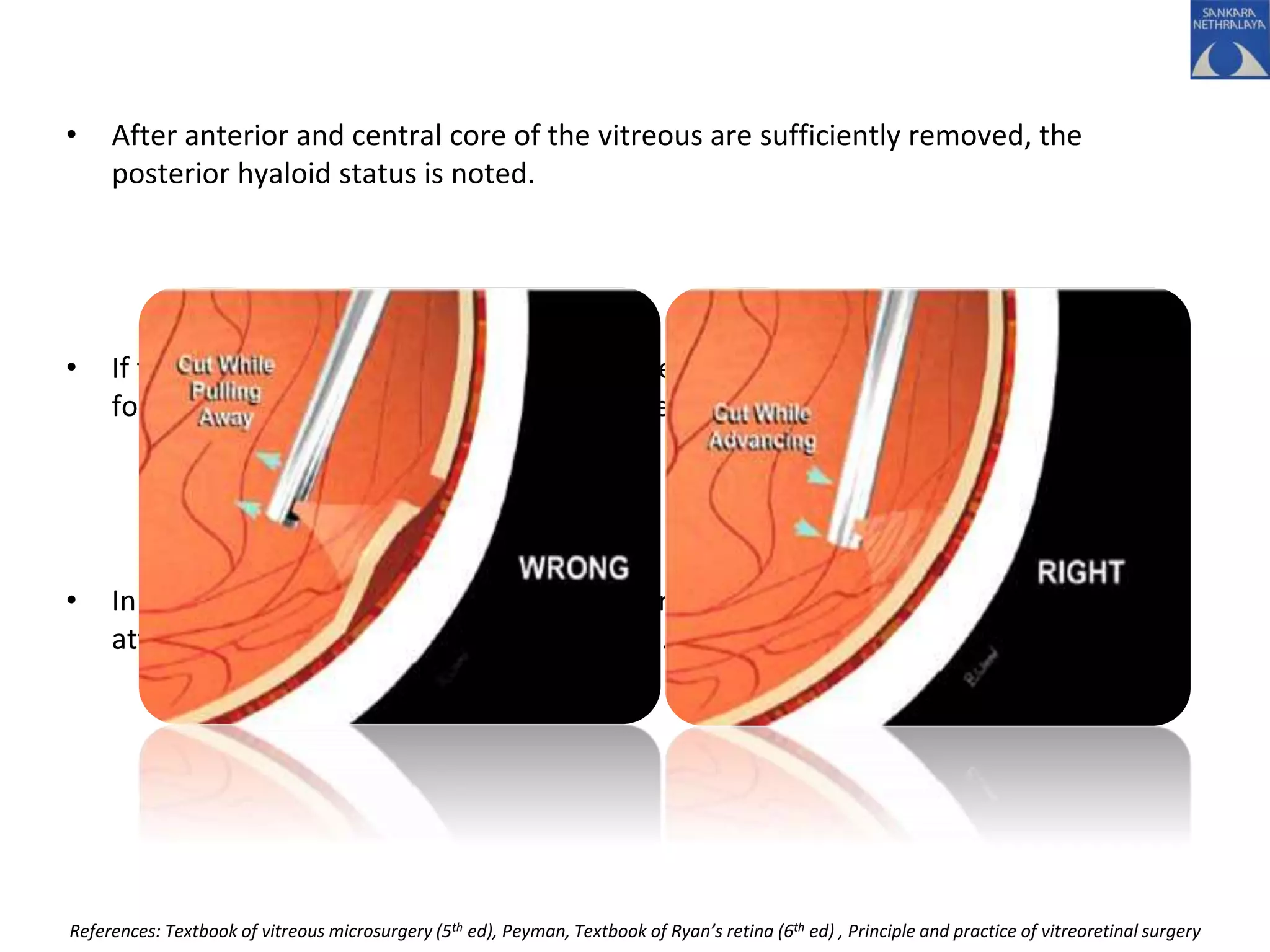 • After anterior and central core of the vitreous are sufficiently removed, the
posterior hyaloid status is noted.
• If there is a CPVD: Opening is created in the posterior hyaloid at one side and this is
followed out to the periphery and circumferentially
• In partial PVD; a complete PVD should be induced from the disc outward, over
attached retina and away from the macula.
References: Textbook of vitreous microsurgery (5th ed), Peyman, Textbook of Ryan’s retina (6th ed) , Principle and practice of vitreoretinal surgery
 