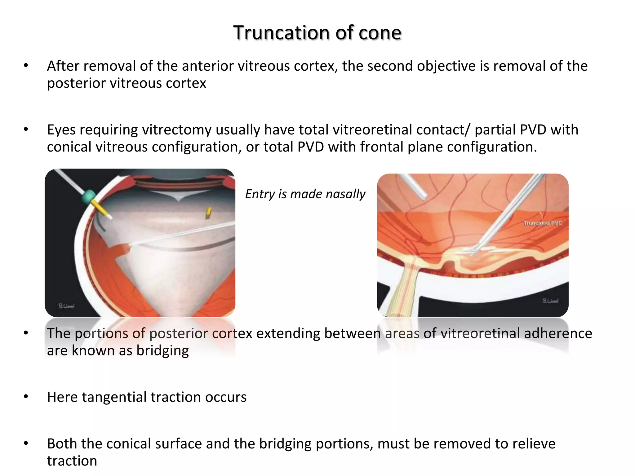 Truncation of cone
• After removal of the anterior vitreous cortex, the second objective is removal of the
posterior vitreous cortex
• Eyes requiring vitrectomy usually have total vitreoretinal contact/ partial PVD with
conical vitreous configuration, or total PVD with frontal plane configuration.
Entry is made nasally
• The portions of posterior cortex extending between areas of vitreoretinal adherence
are known as bridging
• Here tangential traction occurs
• Both the conical surface and the bridging portions, must be removed to relieve
traction
 