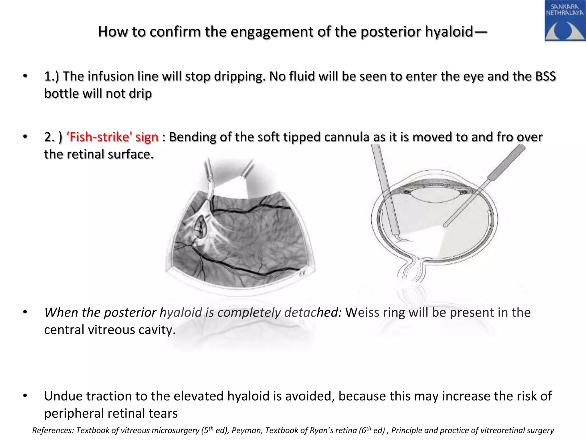 How to confirm the engagement of the posterior hyaloid—
• 1.) The infusion line will stop dripping. No fluid will be seen to enter the eye and the BSS
bottle will not drip
• 2. ) ‘Fish-strike' sign : Bending of the soft tipped cannula as it is moved to and fro over
the retinal surface.
• When the posterior hyaloid is completely detached: Weiss ring will be present in the
central vitreous cavity.
• Undue traction to the elevated hyaloid is avoided, because this may increase the risk of
peripheral retinal tears
References: Textbook of vitreous microsurgery (5th ed), Peyman, Textbook of Ryan’s retina (6th ed) , Principle and practice of vitreoretinal surgery
 