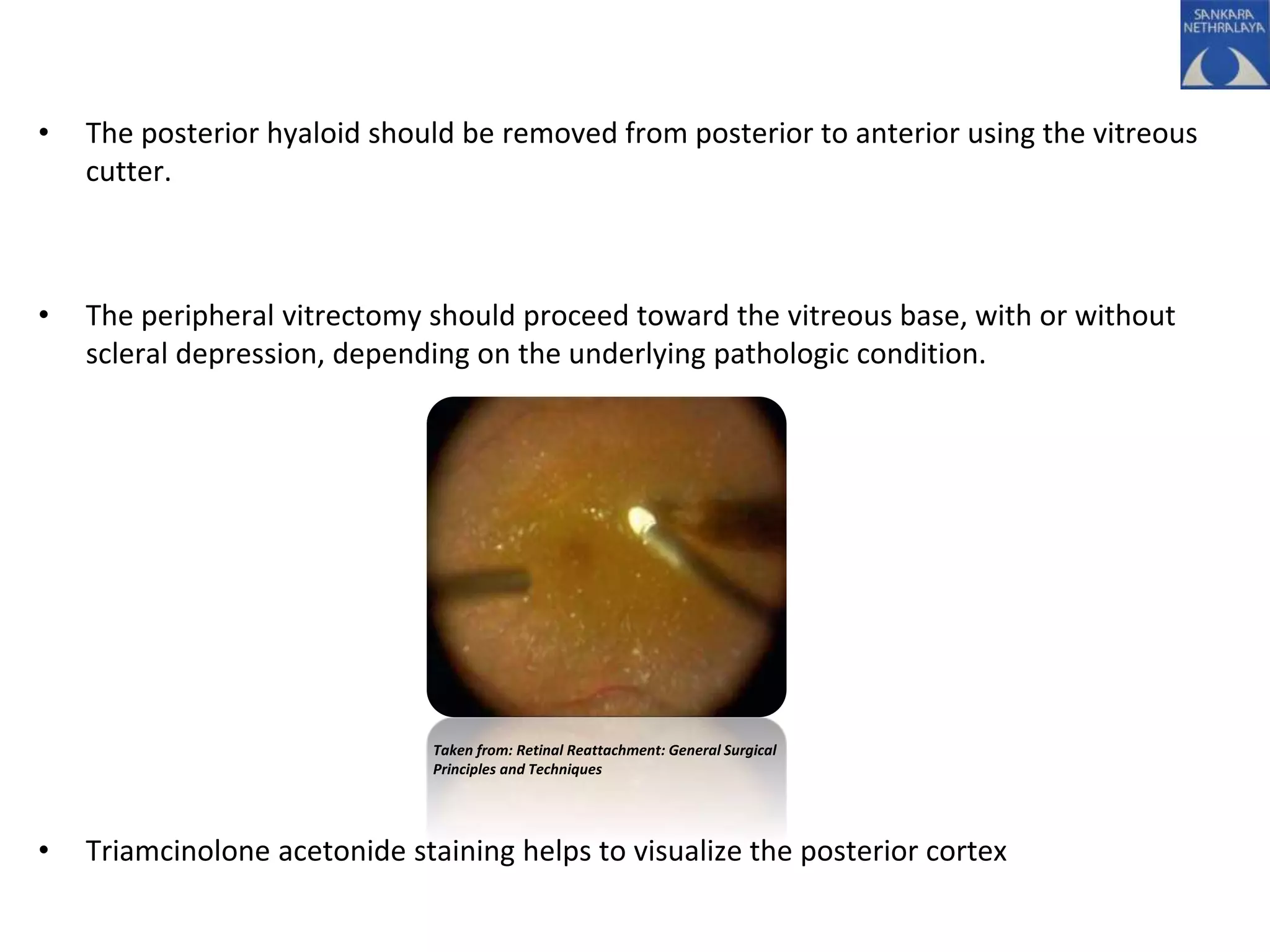 • The posterior hyaloid should be removed from posterior to anterior using the vitreous
cutter.
• The peripheral vitrectomy should proceed toward the vitreous base, with or without
scleral depression, depending on the underlying pathologic condition.
• Triamcinolone acetonide staining helps to visualize the posterior cortex
Taken from: Retinal Reattachment: General Surgical
Principles and Techniques
 