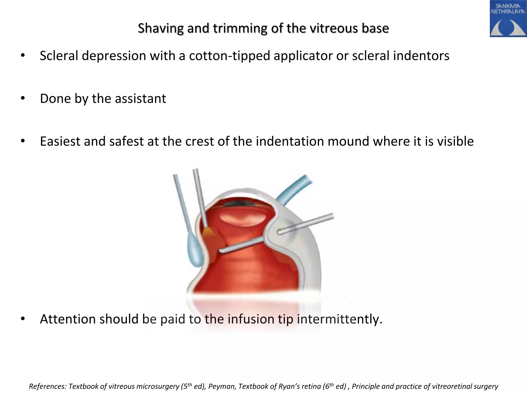 Shaving and trimming of the vitreous base
• Scleral depression with a cotton-tipped applicator or scleral indentors
• Done by the assistant
• Easiest and safest at the crest of the indentation mound where it is visible
• Attention should be paid to the infusion tip intermittently.
References: Textbook of vitreous microsurgery (5th ed), Peyman, Textbook of Ryan’s retina (6th ed) , Principle and practice of vitreoretinal surgery
 