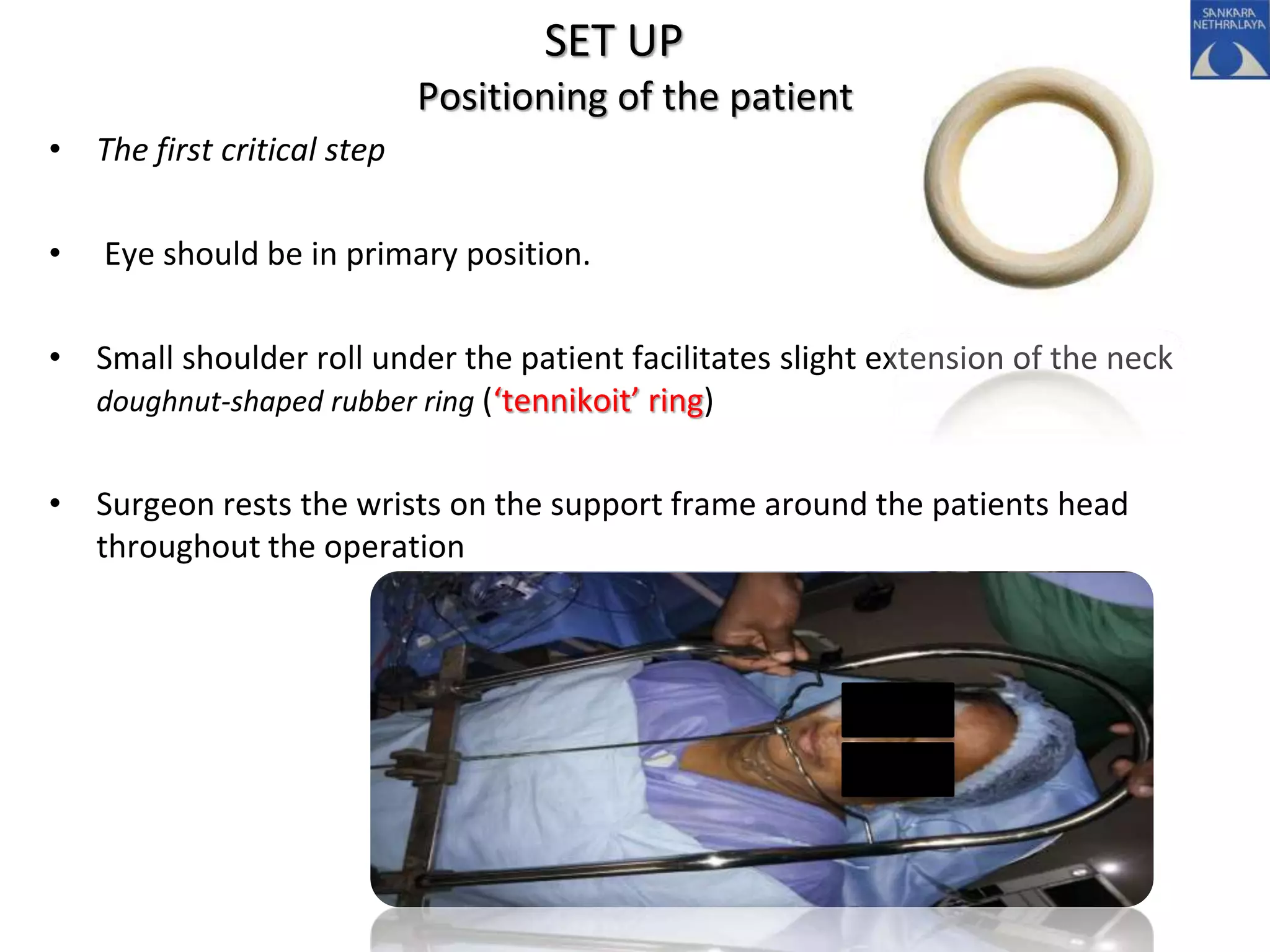 SET UP
Positioning of the patient
• The first critical step
• Eye should be in primary position.
• Small shoulder roll under the patient facilitates slight extension of the neck
doughnut-shaped rubber ring (‘tennikoit’ ring)
• Surgeon rests the wrists on the support frame around the patients head
throughout the operation
 