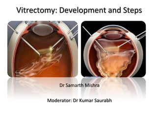 Vitrectomy: Development and Steps
Dr Samarth Mishra
Moderator: Dr Kumar Saurabh
 