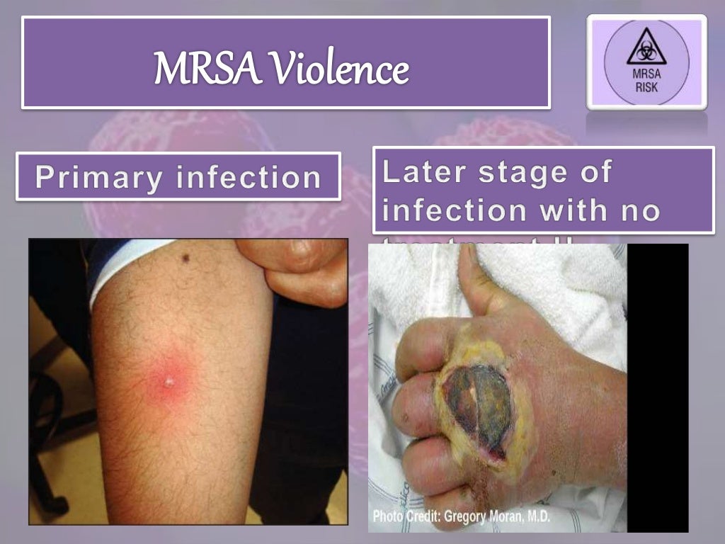 MRSA