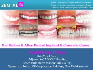 Email:- info@dentalimplantsclinicindia.com
Phone:- +91-9971237409 / +91-9310158505
Website:- www.dentalimplantsclinicindia.com
Our Before & After Dental Implant & Cosmetic Cases.
Zental Dental Clinic
26/1,Yusuf Sarai,
Adjacent to "ADIVA" Hospital,
Green Park Metro Station Gate No. "3",
Opposite to Indian Oil Corporation Building, New Delhi-110016
 