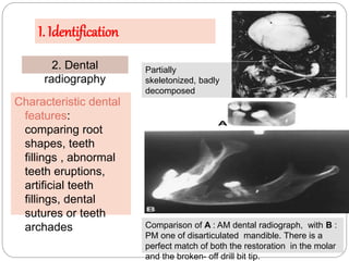 I. Identification
2. Dental
radiography
Partially
skeletonized, badly
decomposed
remains of a female
body.
Characteristic ...