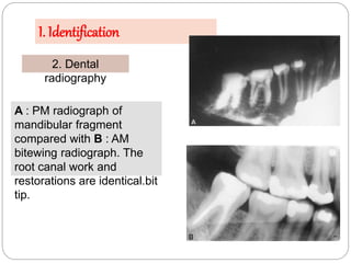 I. Identification
2. Dental
radiography
A : PM radiograph of
mandibular fragment
compared with B : AM
bitewing radiograph....