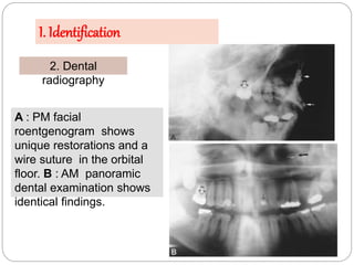 I. Identification
2. Dental
radiography
A : PM facial
roentgenogram shows
unique restorations and a
wire suture in the orb...