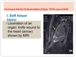 A. Radiology of injury
• Laceration of an
organ: knife wound to
the heart (arrow)
shown by MRI
I. Soft tissue
injury:
II.R...