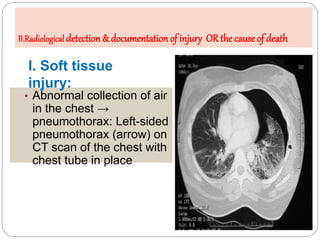 A. Radiology of injury
• Abnormal collection of air
in the chest →
pneumothorax: Left-sided
pneumothorax (arrow) on
CT sca...