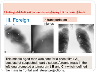 III. Foreign
bodies:
This middle-aged man was sent for a chest film ( A )
because of suspected heart disease. A round mass...