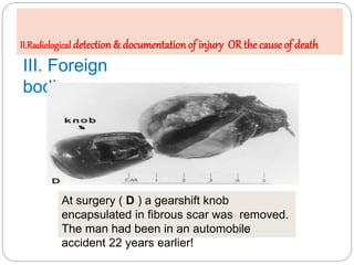III. Foreign
bodies:
At surgery ( D ) a gearshift knob
encapsulated in fibrous scar was removed.
The man had been in an au...