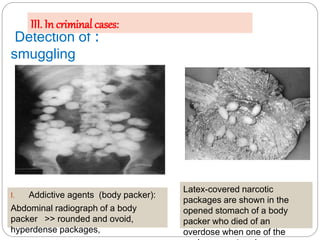 :Detection of
smuggling
I. Addictive agents (body packer):
Abdominal radiograph of a body
packer >> rounded and ovoid,
hyp...