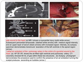 stab wound to the heart (a) MR I shows a myocardial injury (solid white arrow).
Subsequent pericardial tamponade (dashed w...