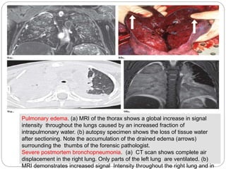 Pulmonary edema. (a) MRI of the thorax shows a global increase in signal
intensity throughout the lungs caused by an incre...