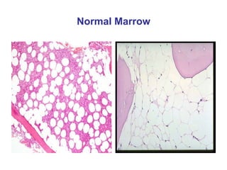 Normal Marrow Elements Approach To A Patient With Anemia | PPTX