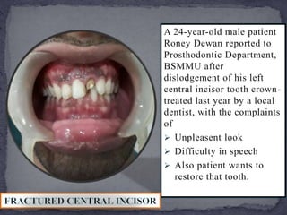 A CASE OF FRACTURED UPPER CENTRAL INCISOR TOOTH RESTORED BY FIBER ...