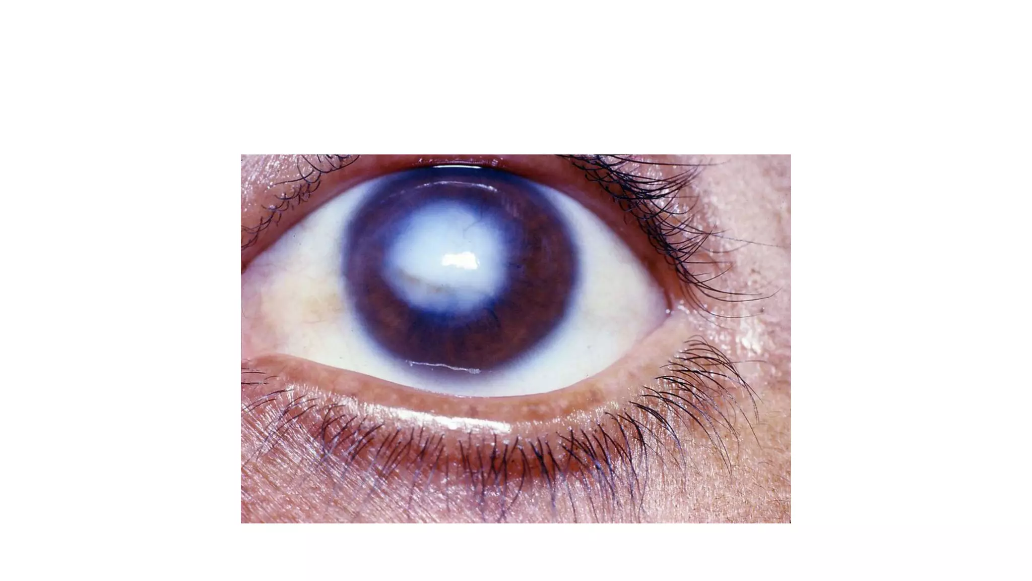 Gradual Visual loss.pptx